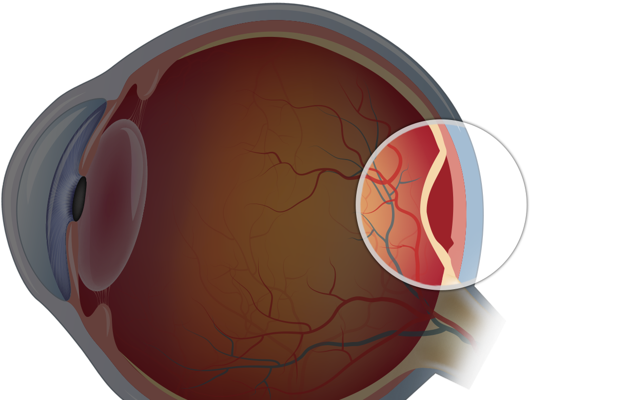recovery from retina detachment surgery forum